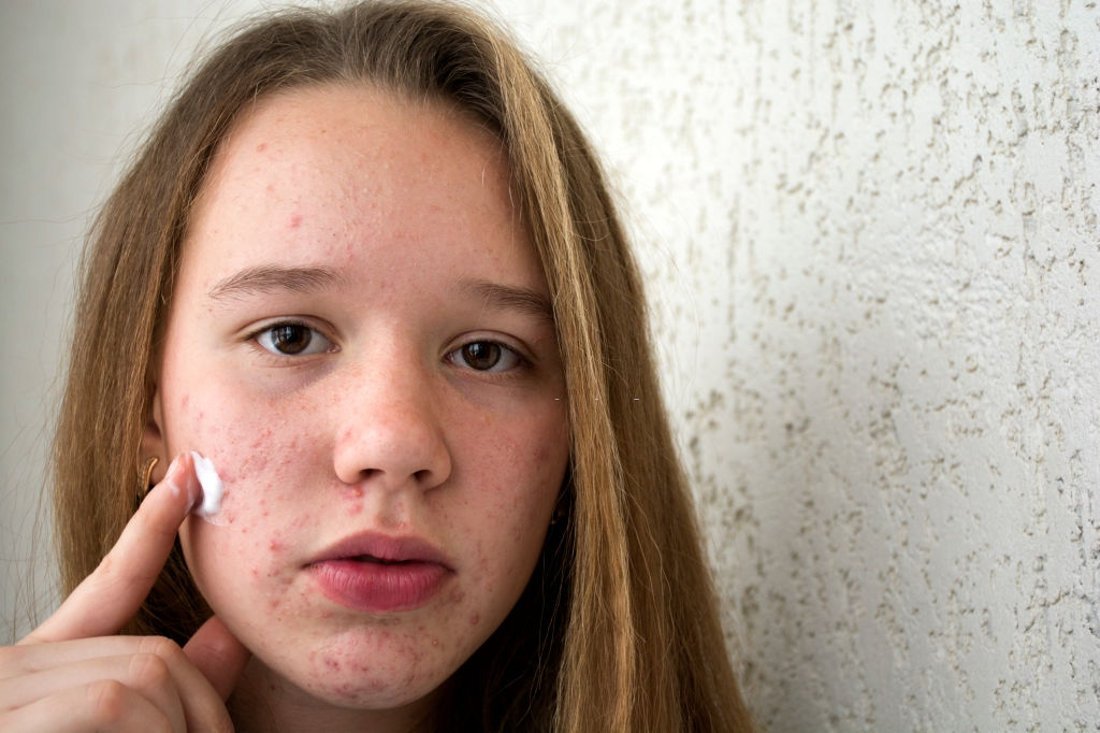 Como tratar cicatrizes da acne